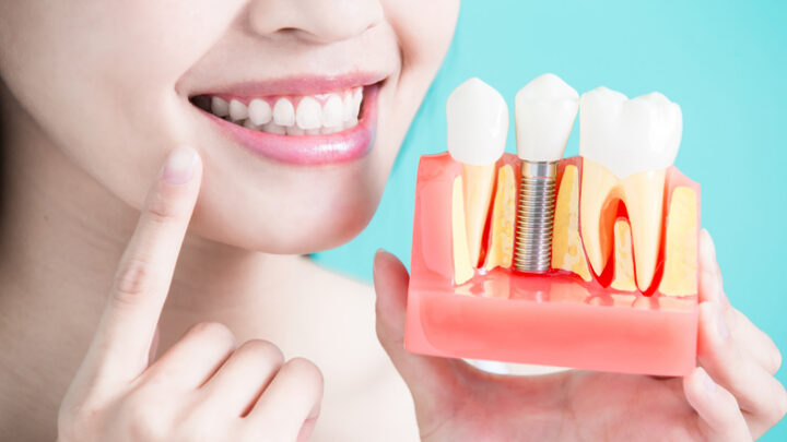 2 especialistas de implantes dentales en Madrid que te recomendamos