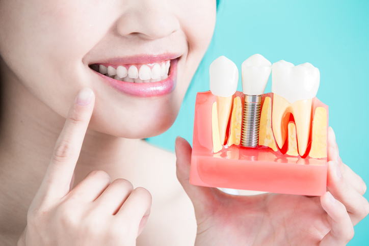 2 especialistas de implantes dentales en Madrid que te recomendamos