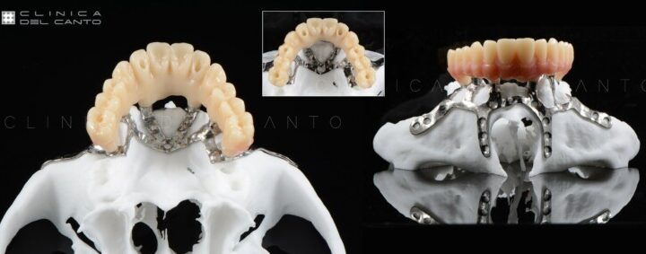 ¿Qué ventajas me ofrecen los implantes dentales con poco hueso o sin hueso?