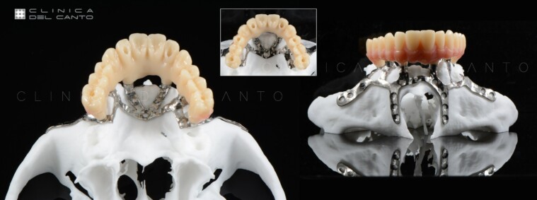 ¿Qué ventajas me ofrecen los implantes dentales con poco hueso o sin hueso?